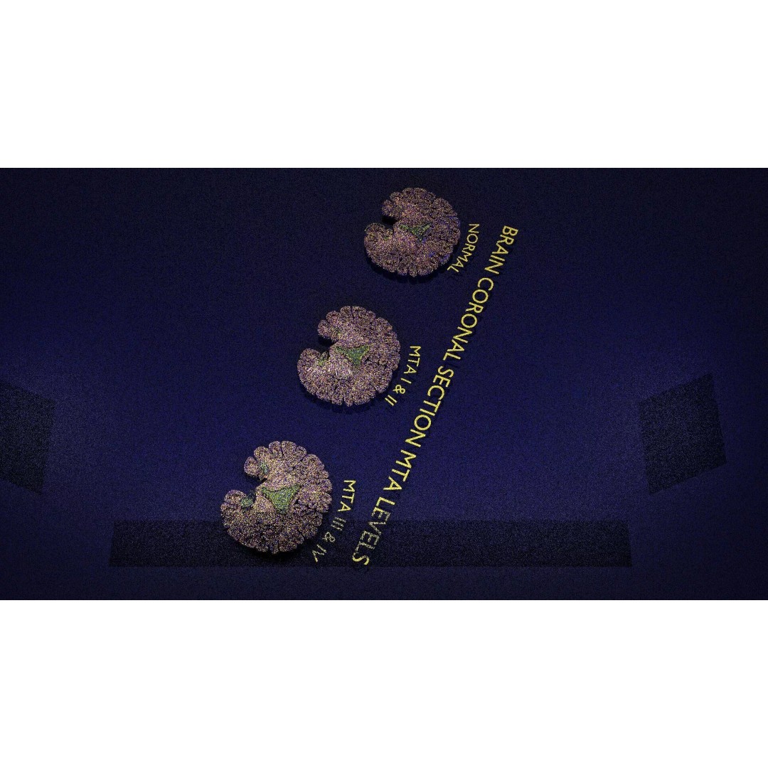 Hippocampus 3D Model – Low Poly MTA Atrophy Levels for Medical Use - View 15