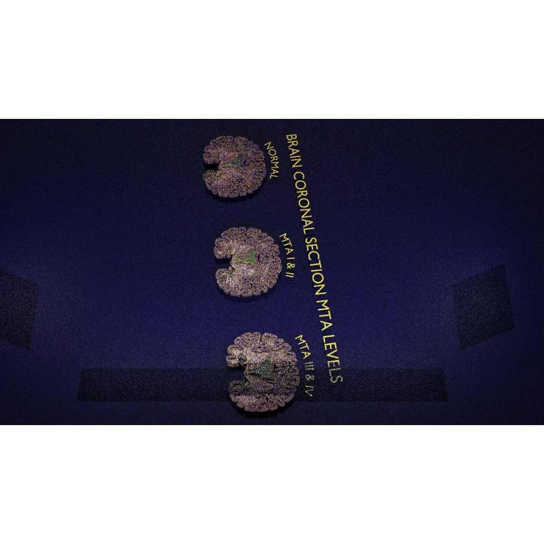 Hippocampus 3D Model – Low Poly MTA Atrophy Levels for Medical Use - View 16