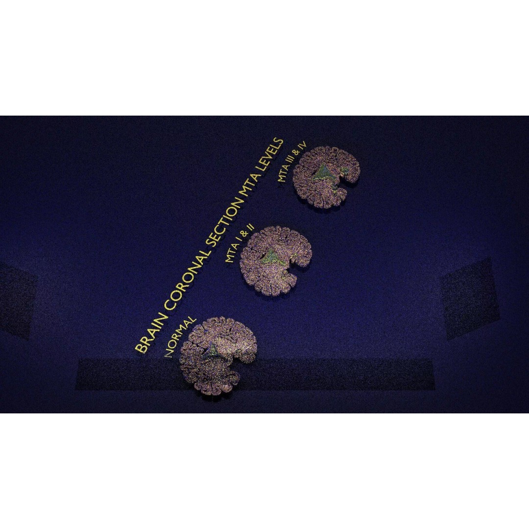 Hippocampus 3D Model – Low Poly MTA Atrophy Levels for Medical Use - View 18
