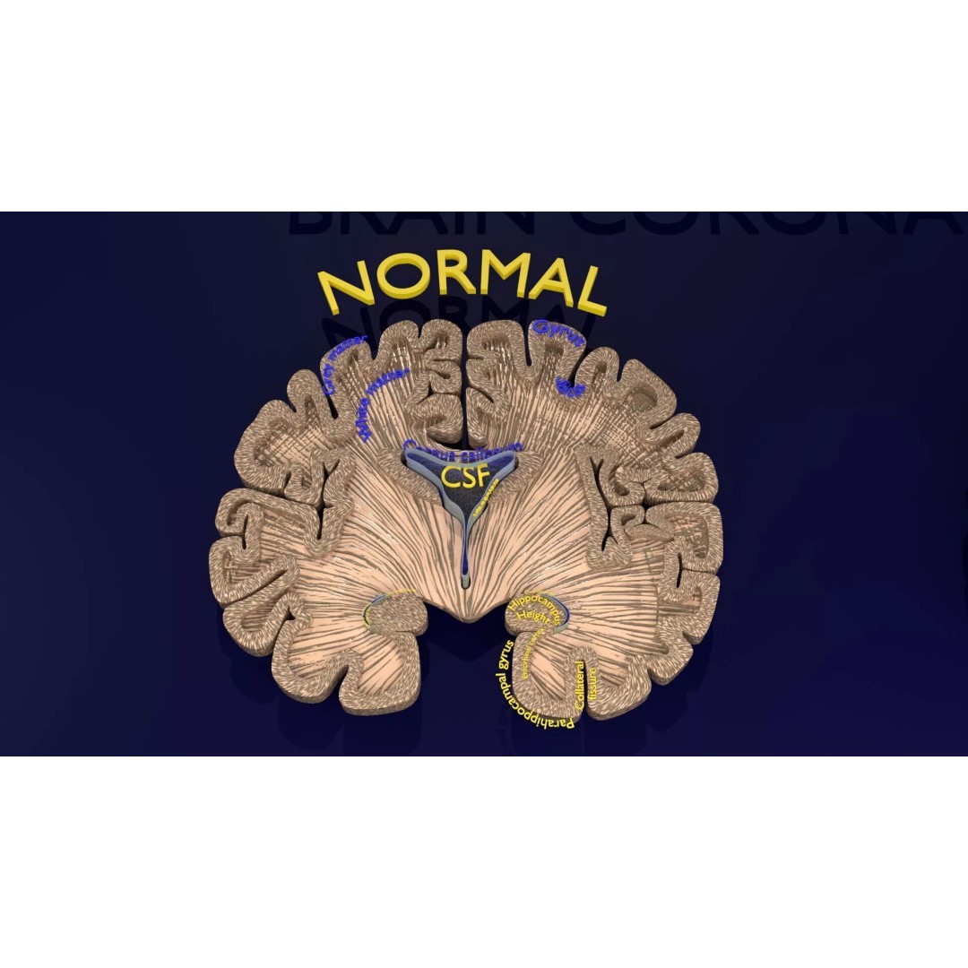 Hippocampus 3D Model – Low Poly MTA Atrophy Levels for Medical Use - View 2