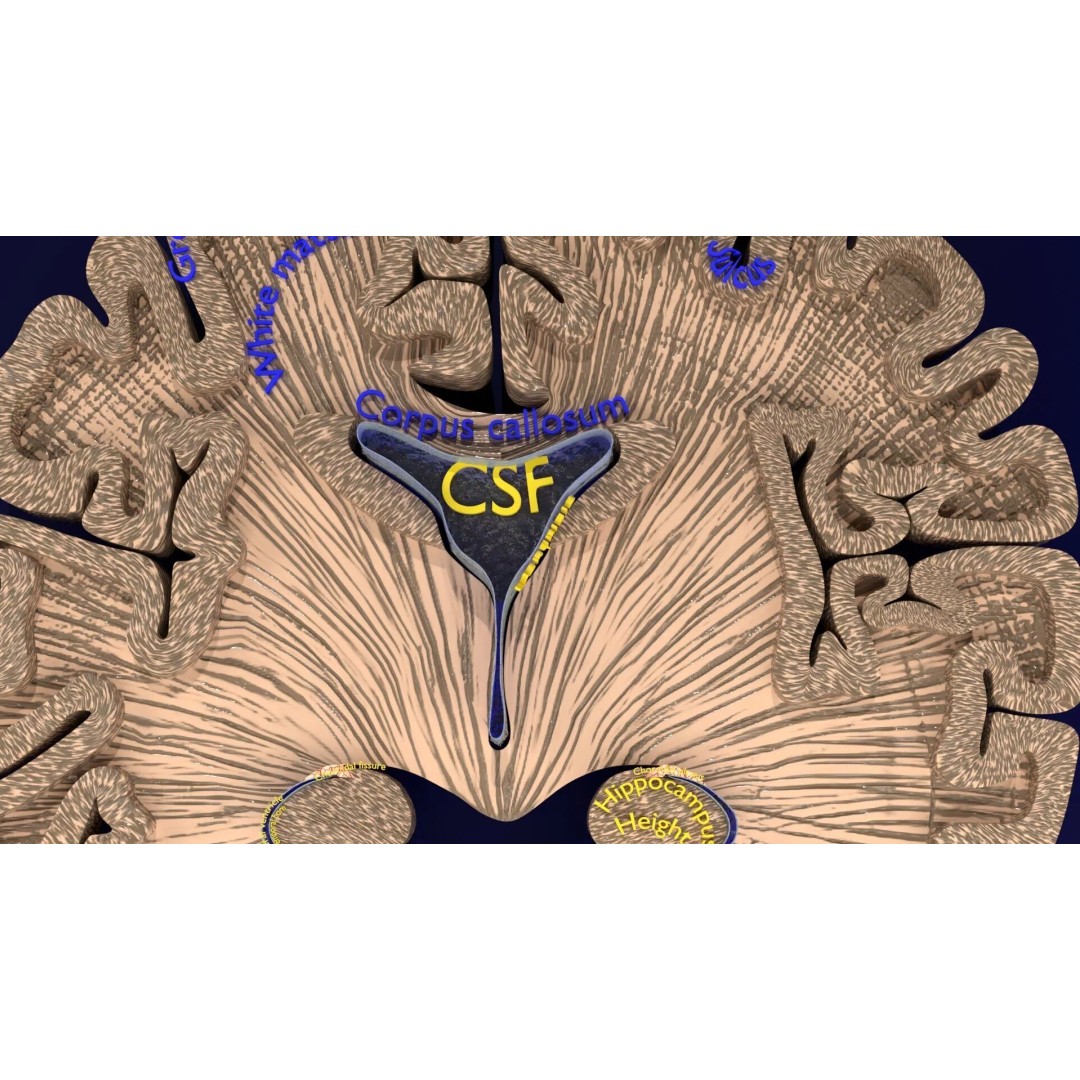 Hippocampus 3D Model – Low Poly MTA Atrophy Levels for Medical Use - View 3