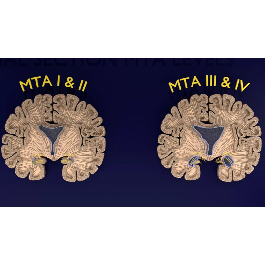 Hippocampus 3D Model – Low Poly MTA Atrophy Levels for Medical Use - View 4