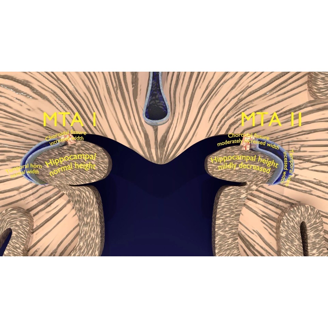 Hippocampus 3D Model – Low Poly MTA Atrophy Levels for Medical Use - View 5