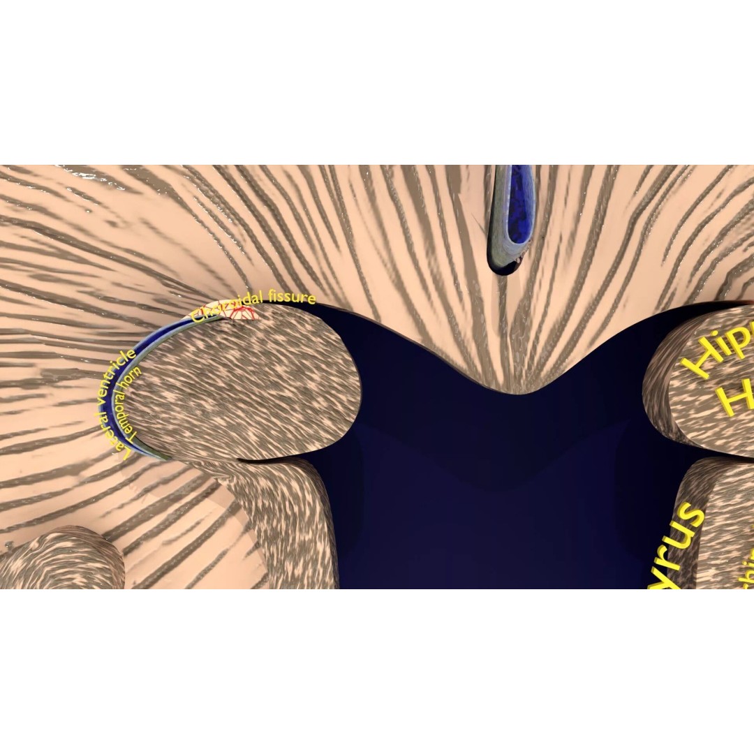 Hippocampus 3D Model – Low Poly MTA Atrophy Levels for Medical Use - View 6