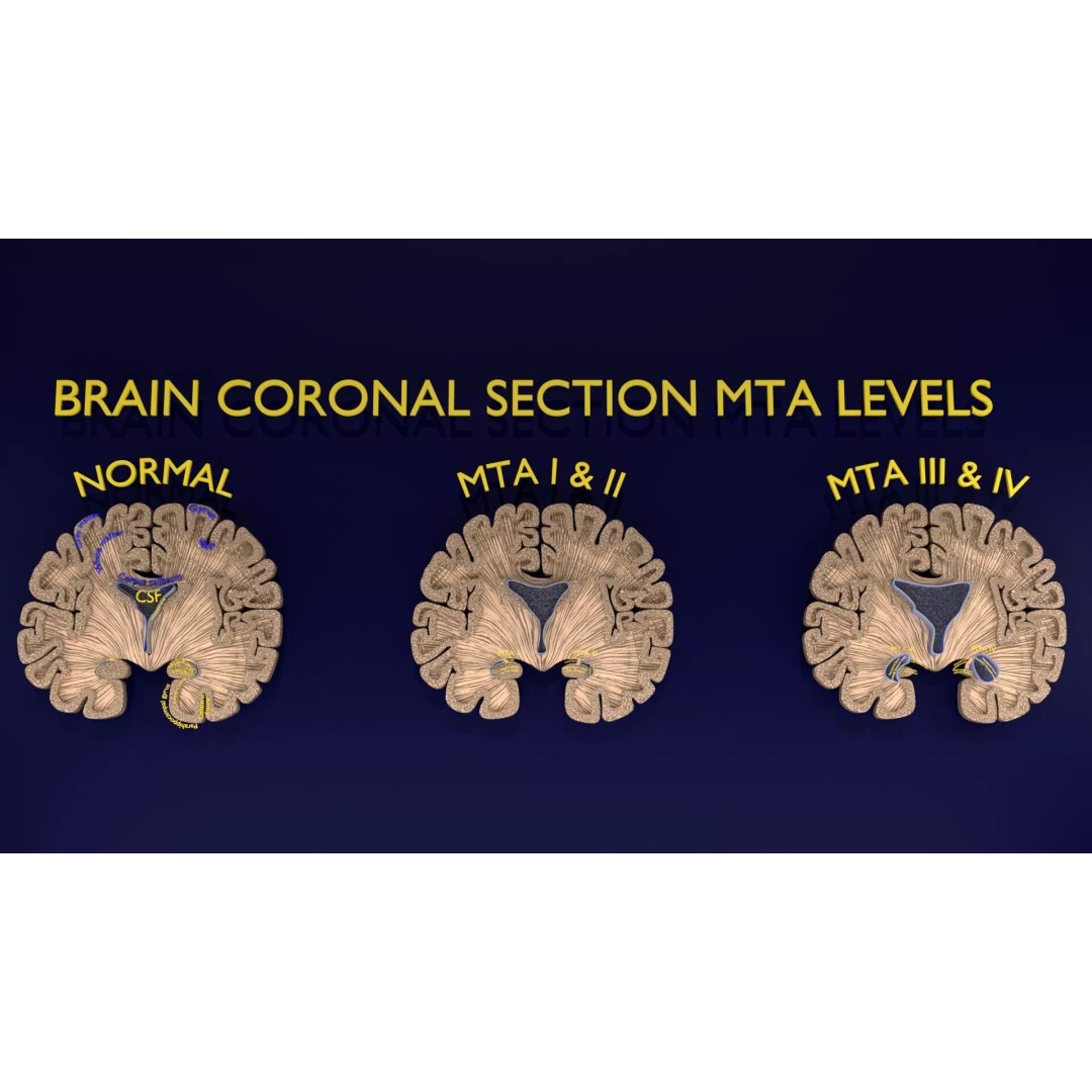 Hippocampus 3D Model – Low Poly MTA Atrophy Levels for Medical Use - View 7
