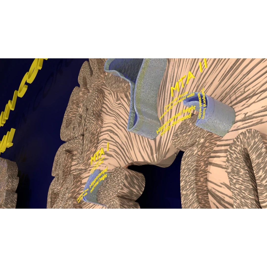 Hippocampus 3D Model – Low Poly MTA Atrophy Levels for Medical Use - View 8
