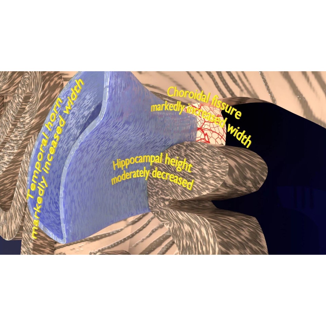 Hippocampus 3D Model – Low Poly MTA Atrophy Levels for Medical Use - View 9