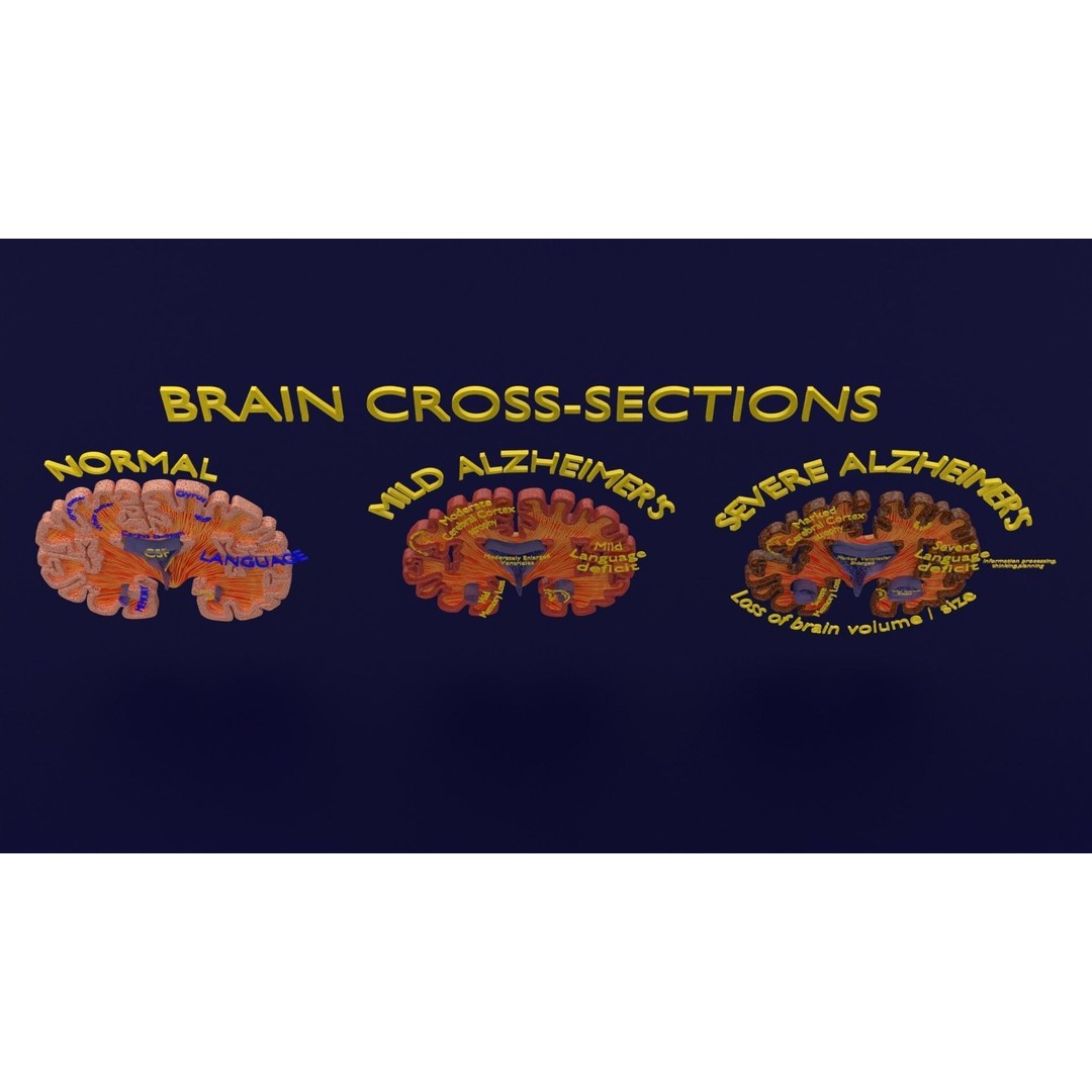 Alzheimer Disease Brain Coronal Slice 3D Model – PBR Textured, Multiple Formats - View 10