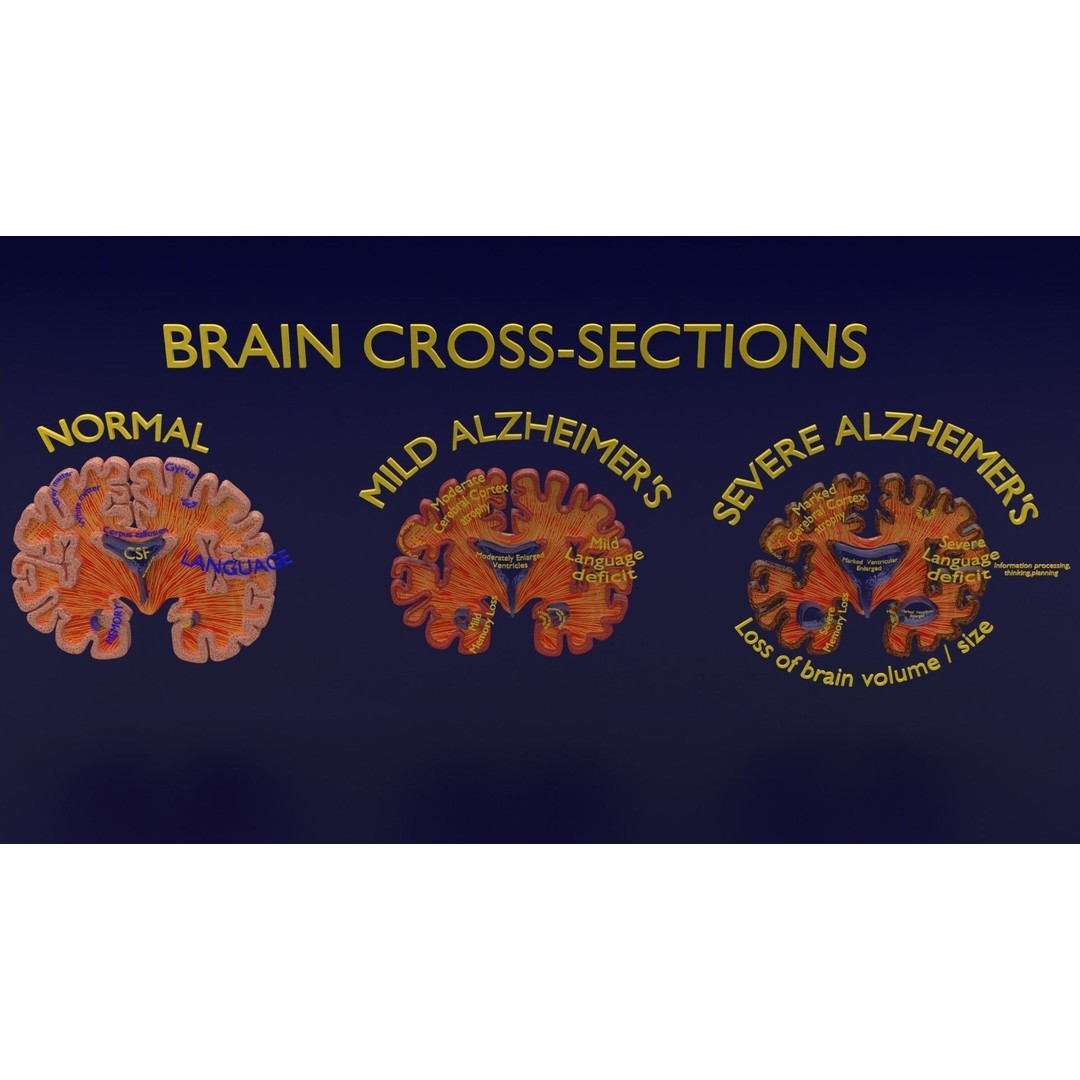 Alzheimer Disease Brain Coronal Slice 3D Model – PBR Textured, Multiple Formats - View 11