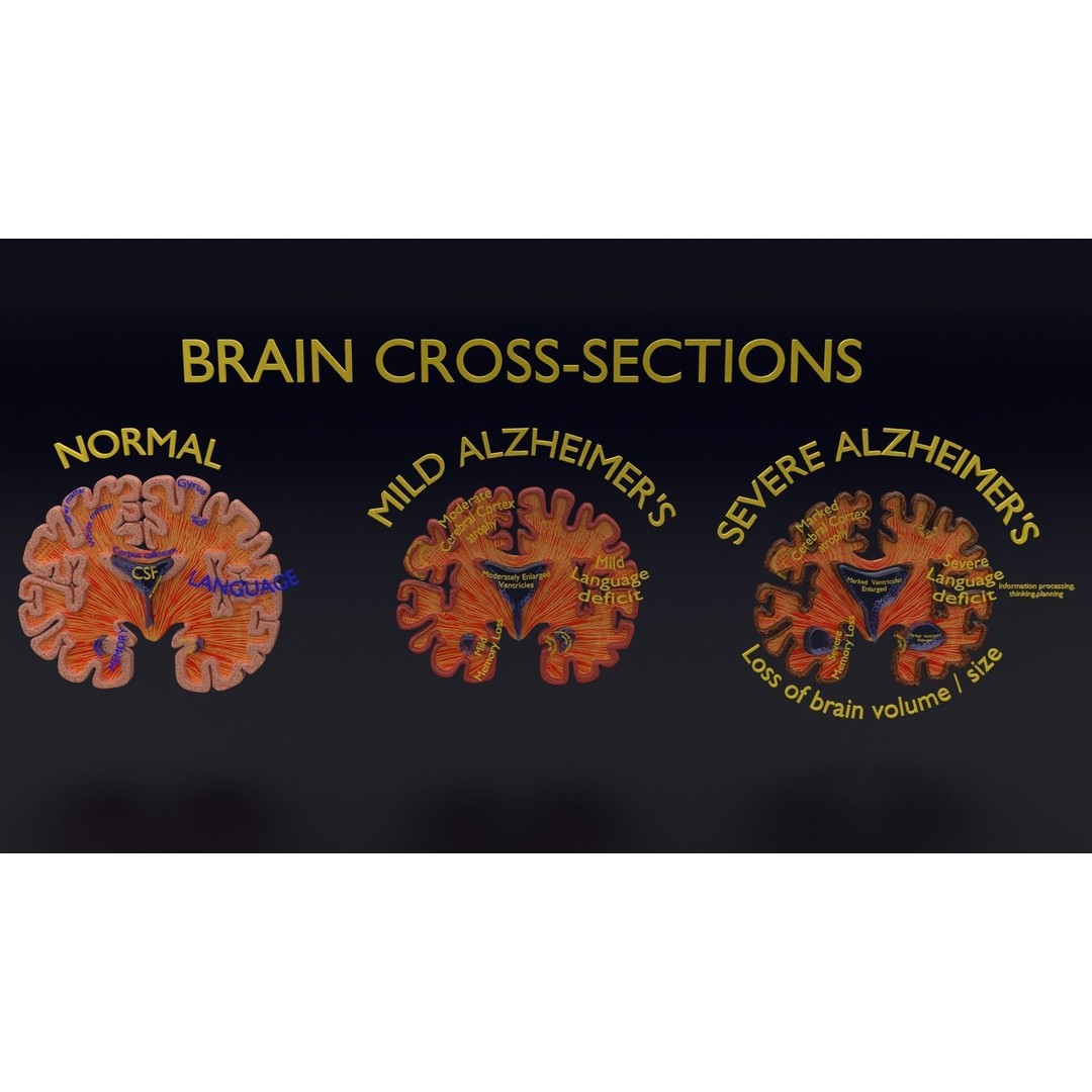 Alzheimer Disease Brain Coronal Slice 3D Model – PBR Textured, Multiple Formats - View 12