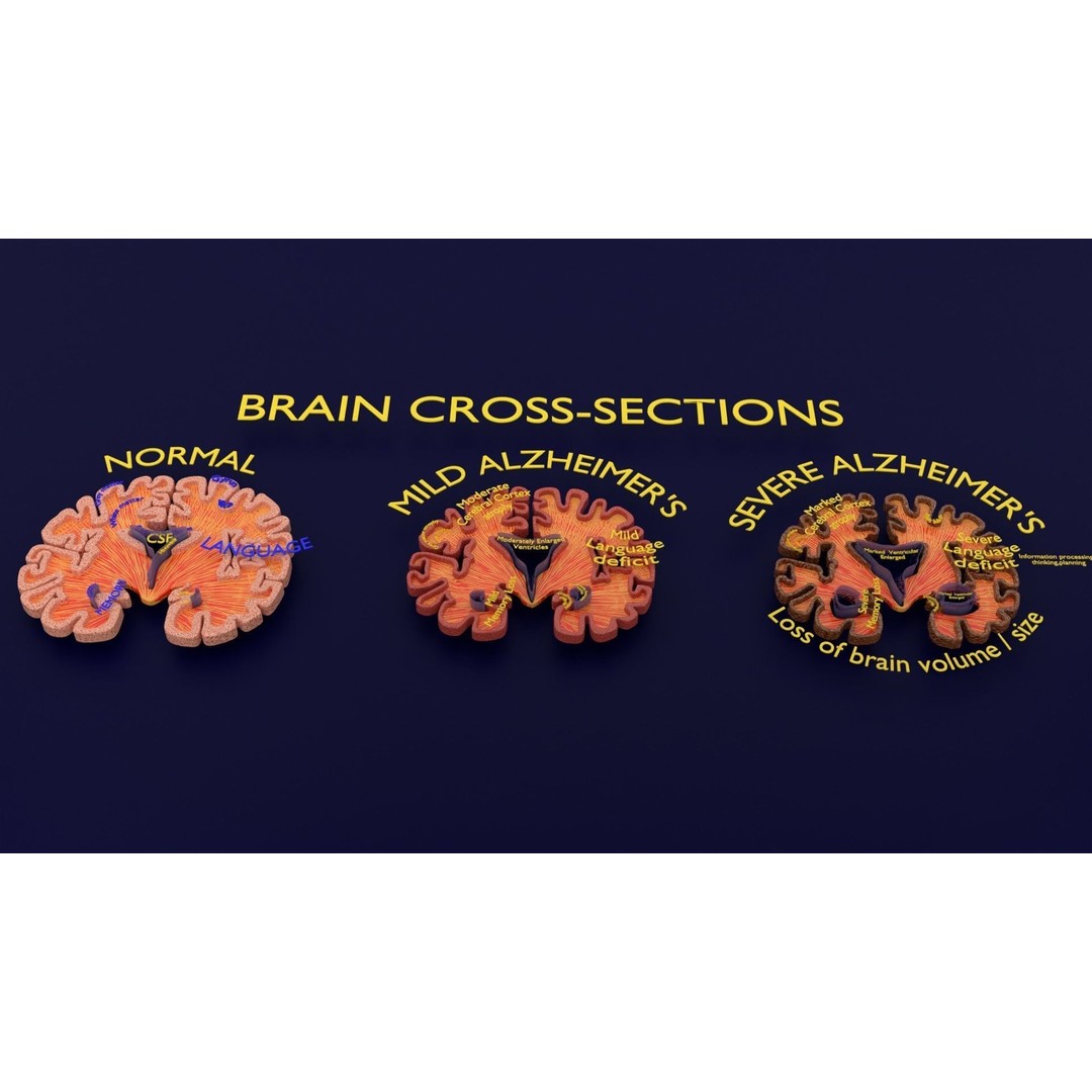 Alzheimer Disease Brain Coronal Slice 3D Model – PBR Textured, Multiple Formats - View 13