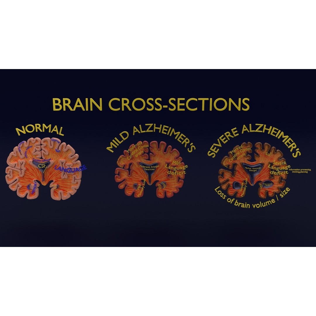 Alzheimer Disease Brain Coronal Slice 3D Model – PBR Textured, Multiple Formats - View 14