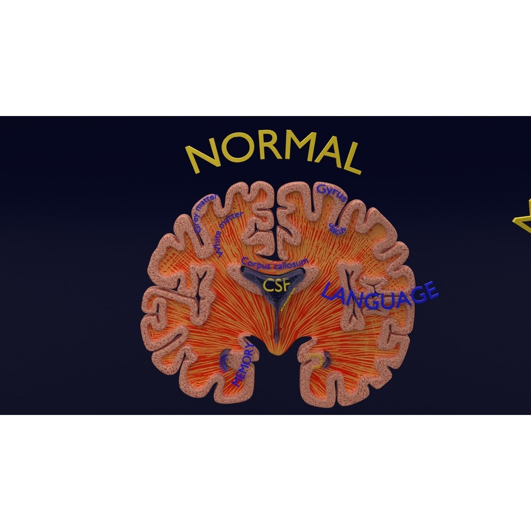 Alzheimer Disease Brain Coronal Slice 3D Model – PBR Textured, Multiple Formats - View 15