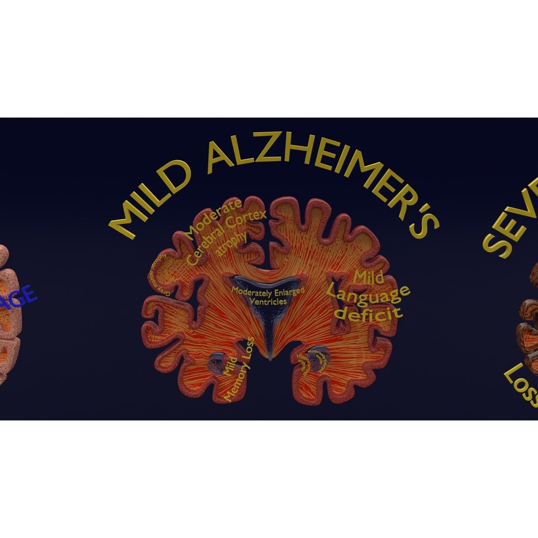 Alzheimer Disease Brain Coronal Slice 3D Model – PBR Textured, Multiple Formats - View 16