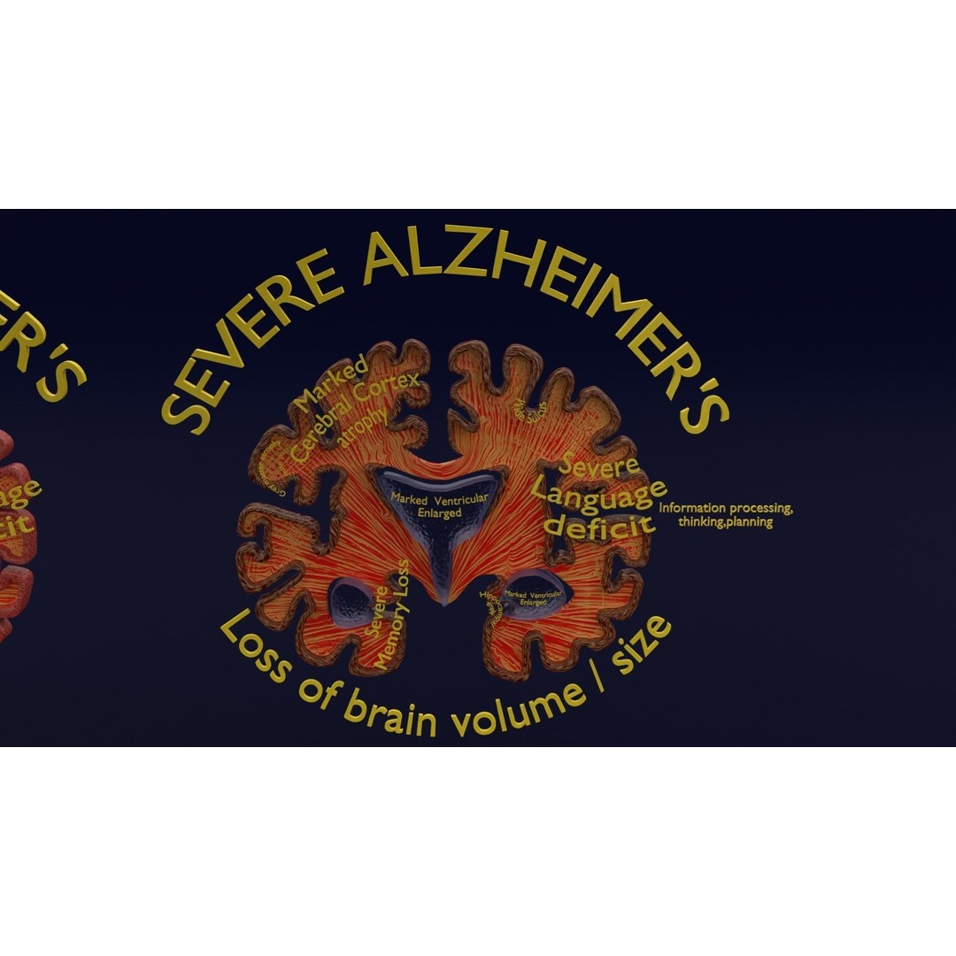 Alzheimer Disease Brain Coronal Slice 3D Model – PBR Textured, Multiple Formats - View 17