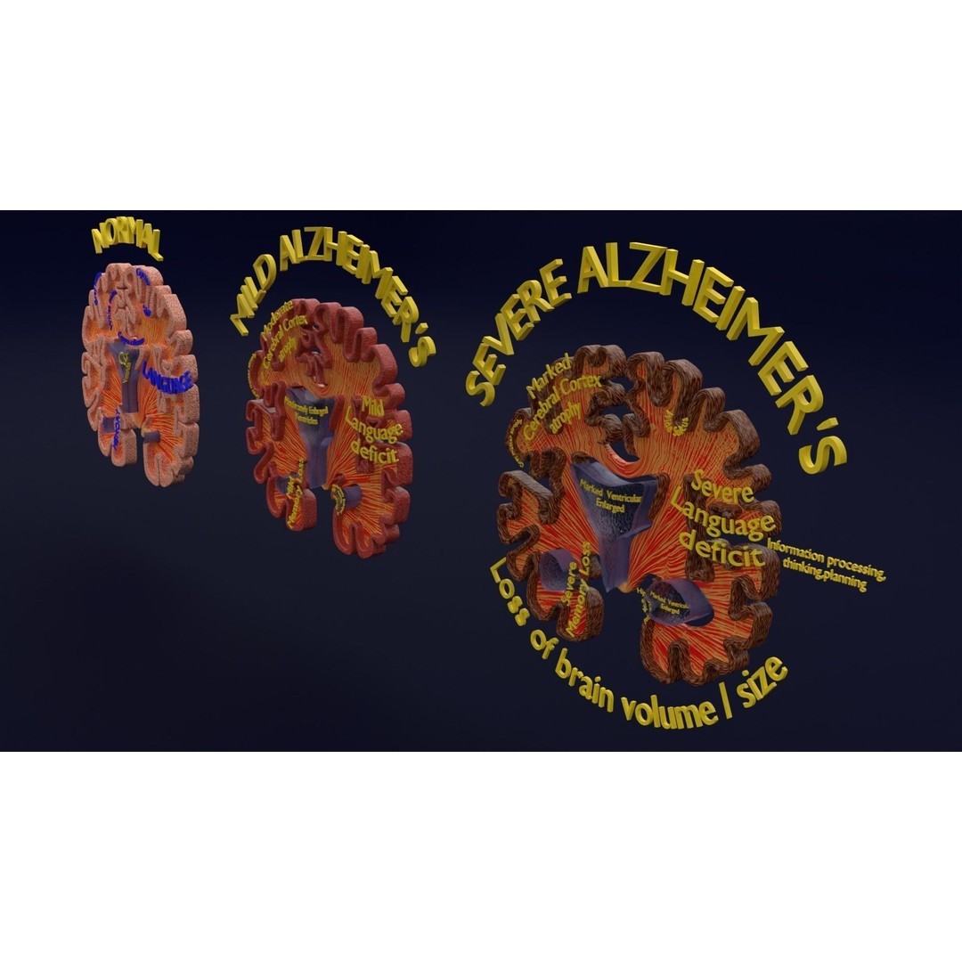 Alzheimer Disease Brain Coronal Slice 3D Model – PBR Textured, Multiple Formats - View 18