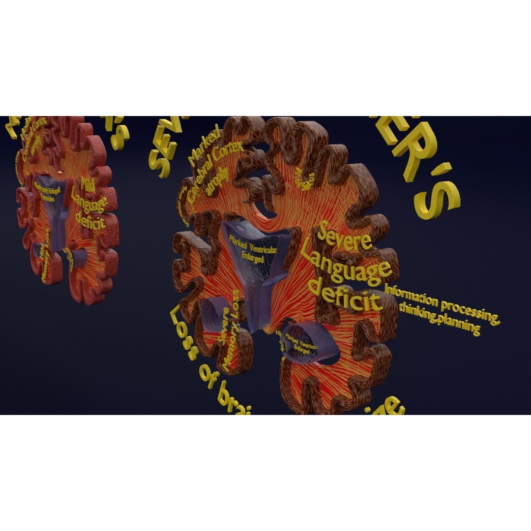 Alzheimer Disease Brain Coronal Slice 3D Model – PBR Textured, Multiple Formats - View 19