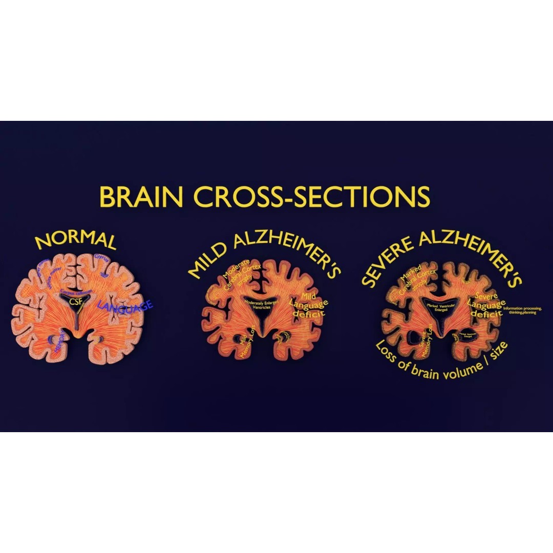 Alzheimer Disease Brain Coronal Slice 3D Model – PBR Textured, Multiple Formats - View 2