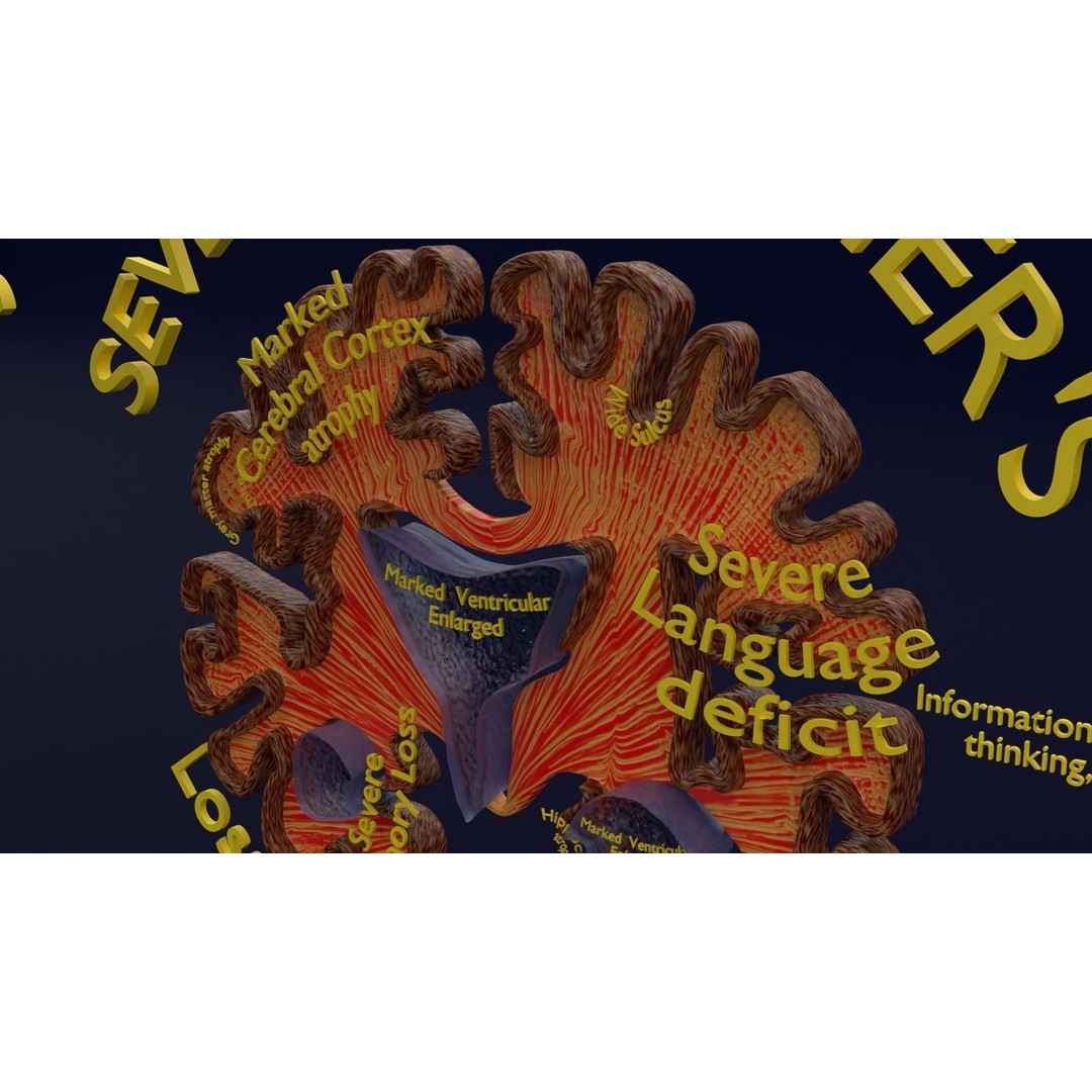 Alzheimer Disease Brain Coronal Slice 3D Model – PBR Textured, Multiple Formats - View 20