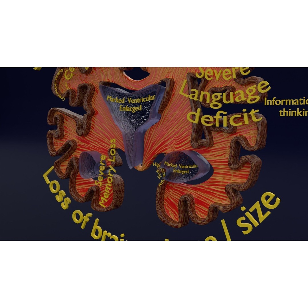 Alzheimer Disease Brain Coronal Slice 3D Model – PBR Textured, Multiple Formats - View 21