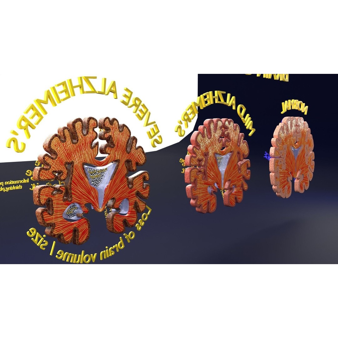Alzheimer Disease Brain Coronal Slice 3D Model – PBR Textured, Multiple Formats - View 23