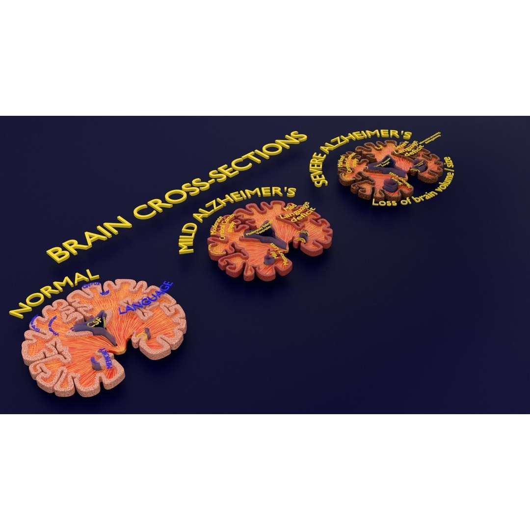 Alzheimer Disease Brain Coronal Slice 3D Model – PBR Textured, Multiple Formats - View 24