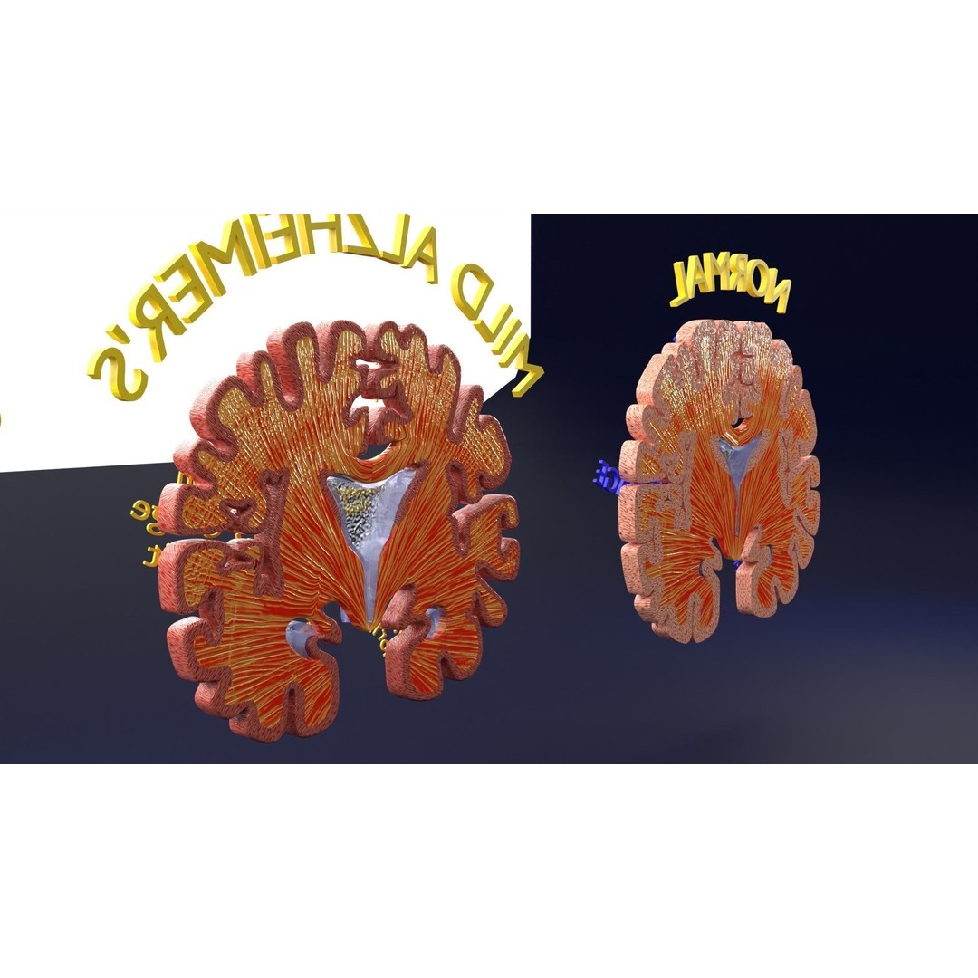 Alzheimer Disease Brain Coronal Slice 3D Model – PBR Textured, Multiple Formats - View 25