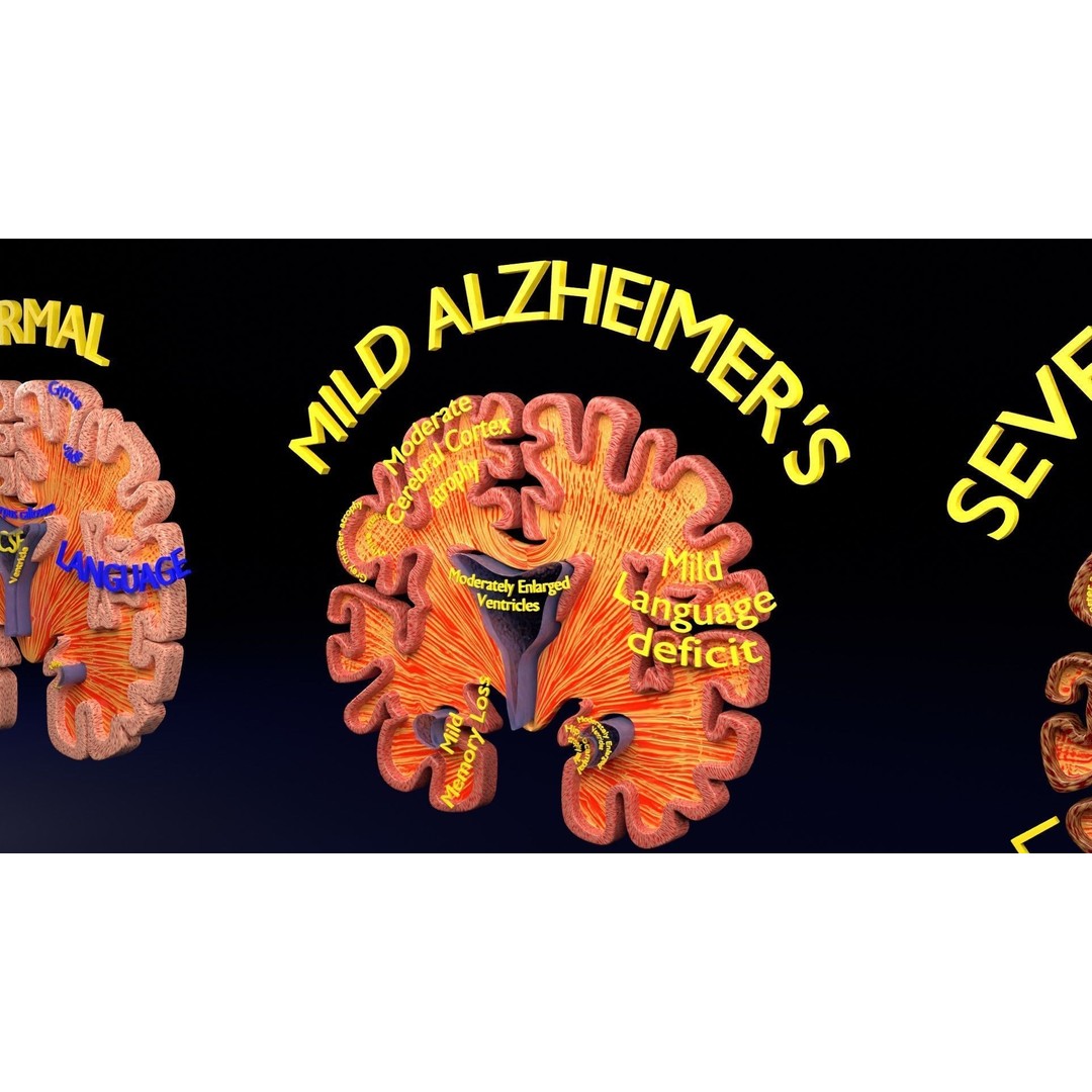 Alzheimer Disease Brain Coronal Slice 3D Model – PBR Textured, Multiple Formats - View 27
