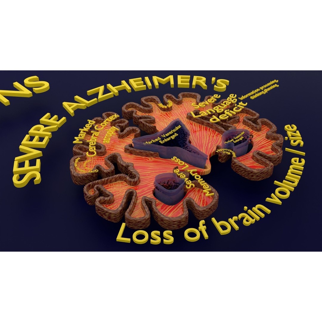 Alzheimer Disease Brain Coronal Slice 3D Model – PBR Textured, Multiple Formats - View 3