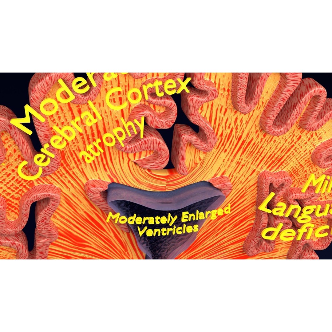 Alzheimer Disease Brain Coronal Slice 3D Model – PBR Textured, Multiple Formats - View 31