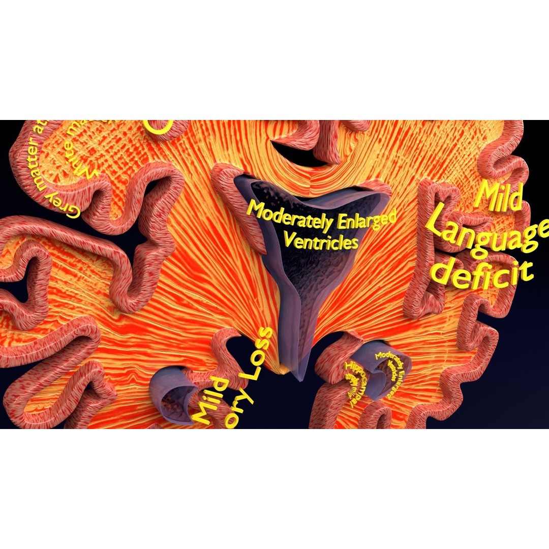 Alzheimer Disease Brain Coronal Slice 3D Model – PBR Textured, Multiple Formats - View 32