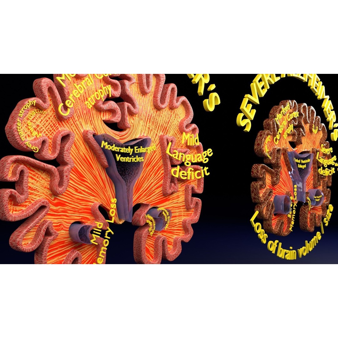 Alzheimer Disease Brain Coronal Slice 3D Model – PBR Textured, Multiple Formats - View 33