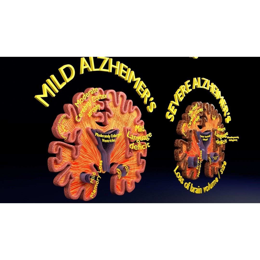 Alzheimer Disease Brain Coronal Slice 3D Model – PBR Textured, Multiple Formats - View 34