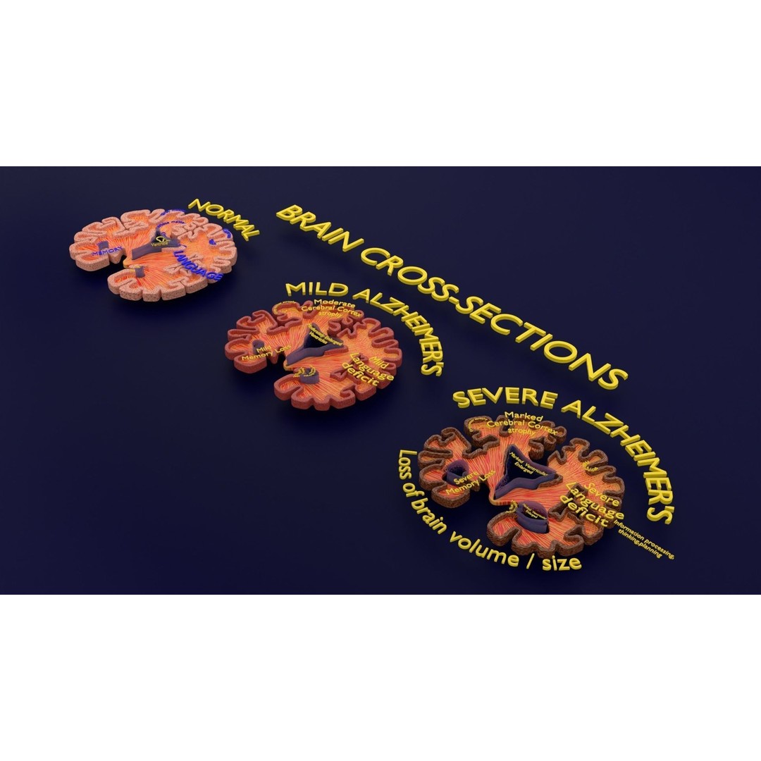 Alzheimer Disease Brain Coronal Slice 3D Model – PBR Textured, Multiple Formats - View 35
