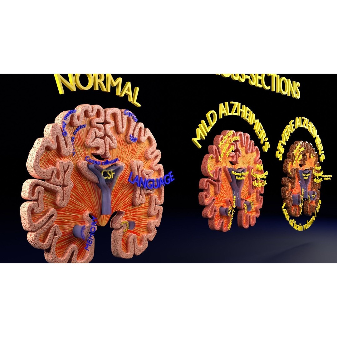 Alzheimer Disease Brain Coronal Slice 3D Model – PBR Textured, Multiple Formats - View 36