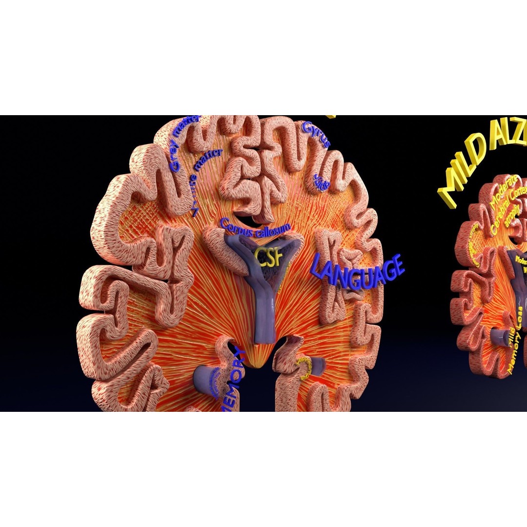 Alzheimer Disease Brain Coronal Slice 3D Model – PBR Textured, Multiple Formats - View 37
