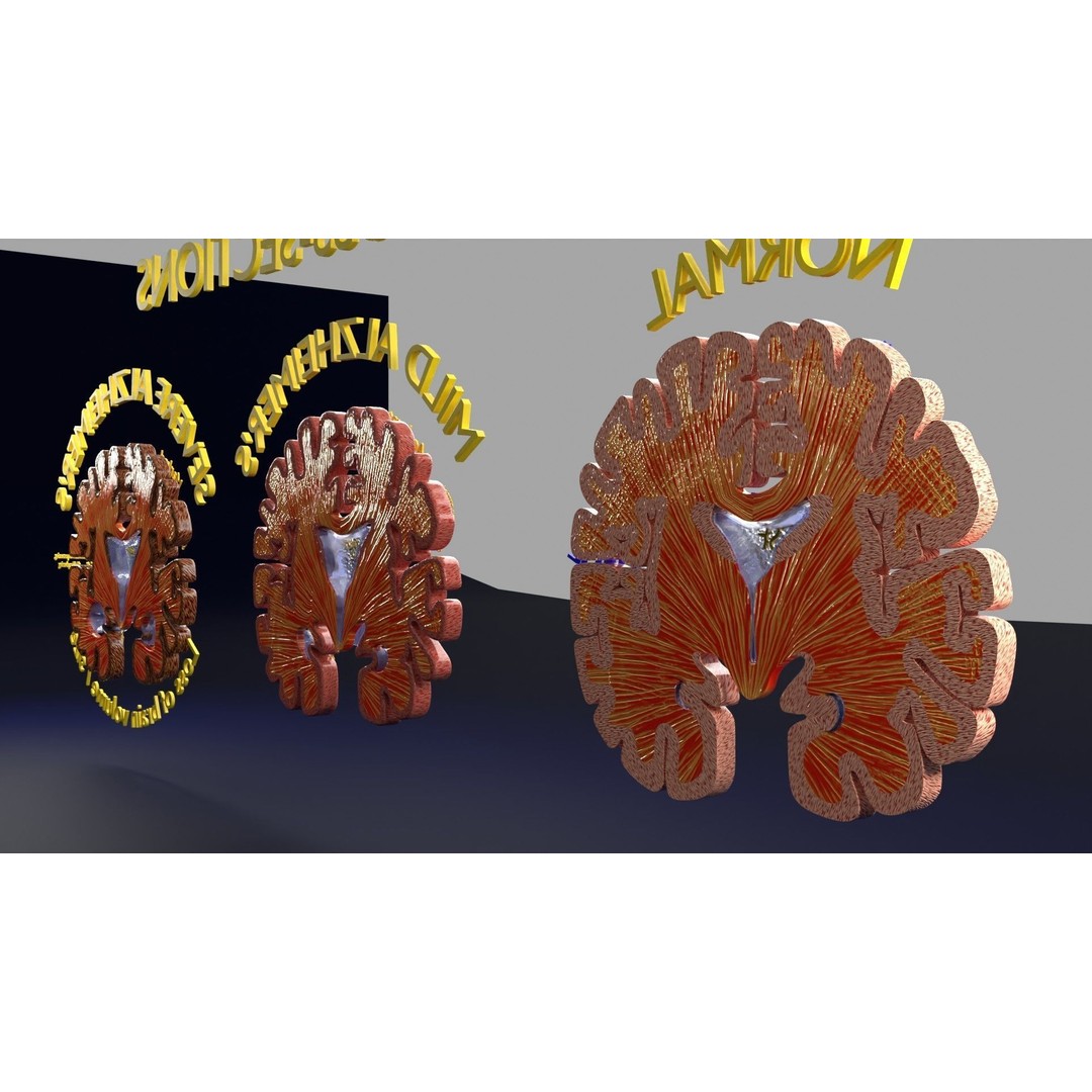 Alzheimer Disease Brain Coronal Slice 3D Model – PBR Textured, Multiple Formats - View 38