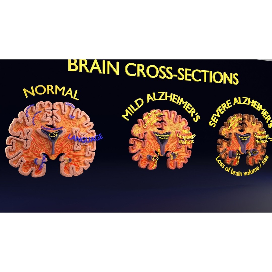 Alzheimer Disease Brain Coronal Slice 3D Model – PBR Textured, Multiple Formats - View 39