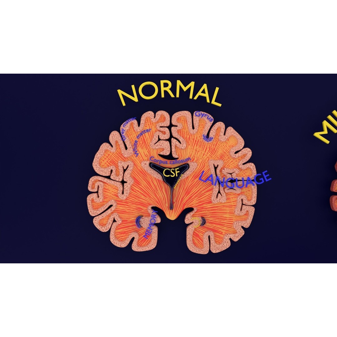 Alzheimer Disease Brain Coronal Slice 3D Model – PBR Textured, Multiple Formats - View 4