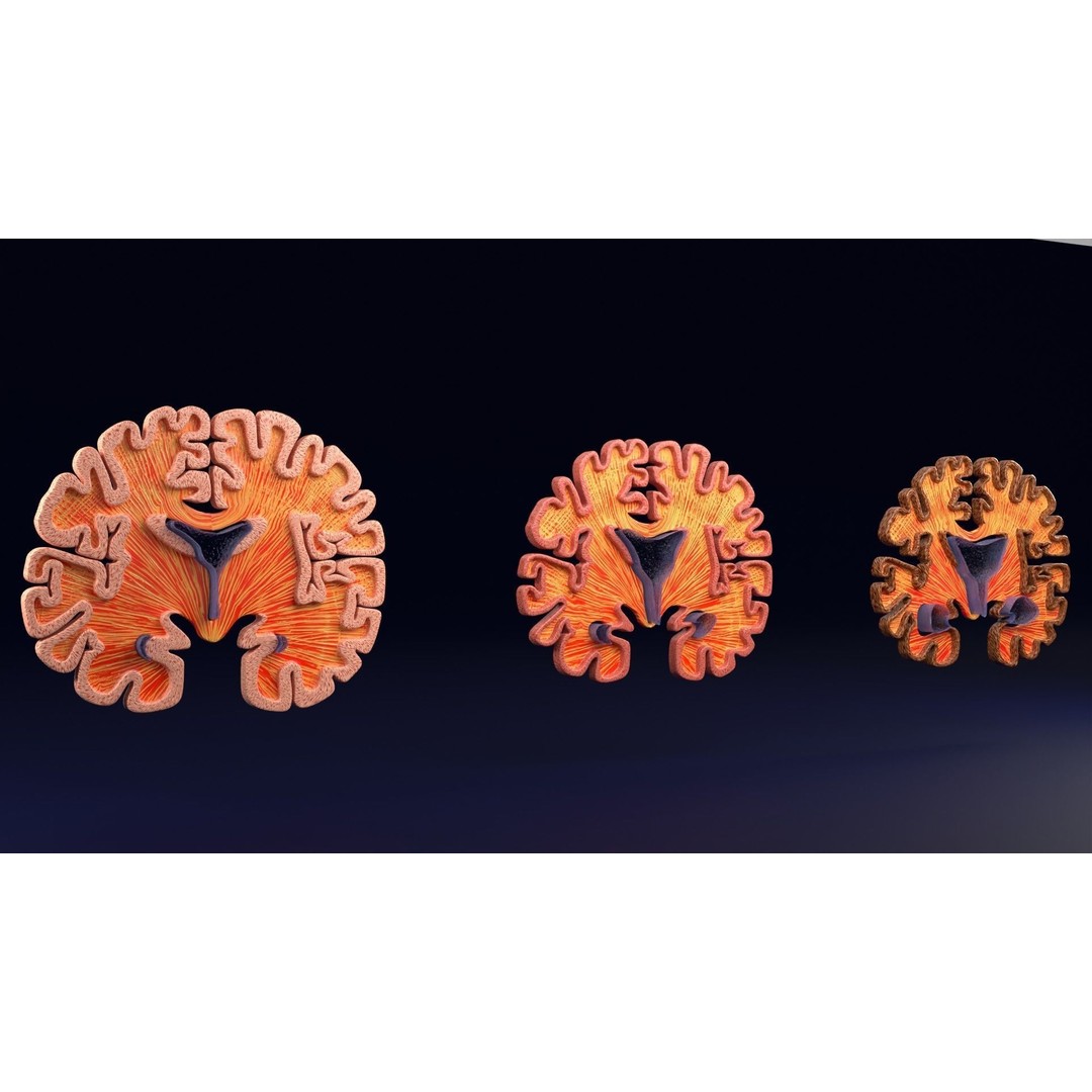 Alzheimer Disease Brain Coronal Slice 3D Model – PBR Textured, Multiple Formats - View 40