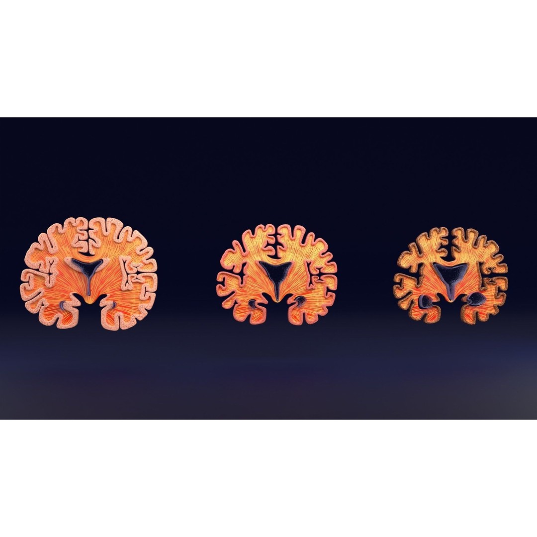 Alzheimer Disease Brain Coronal Slice 3D Model – PBR Textured, Multiple Formats - View 41