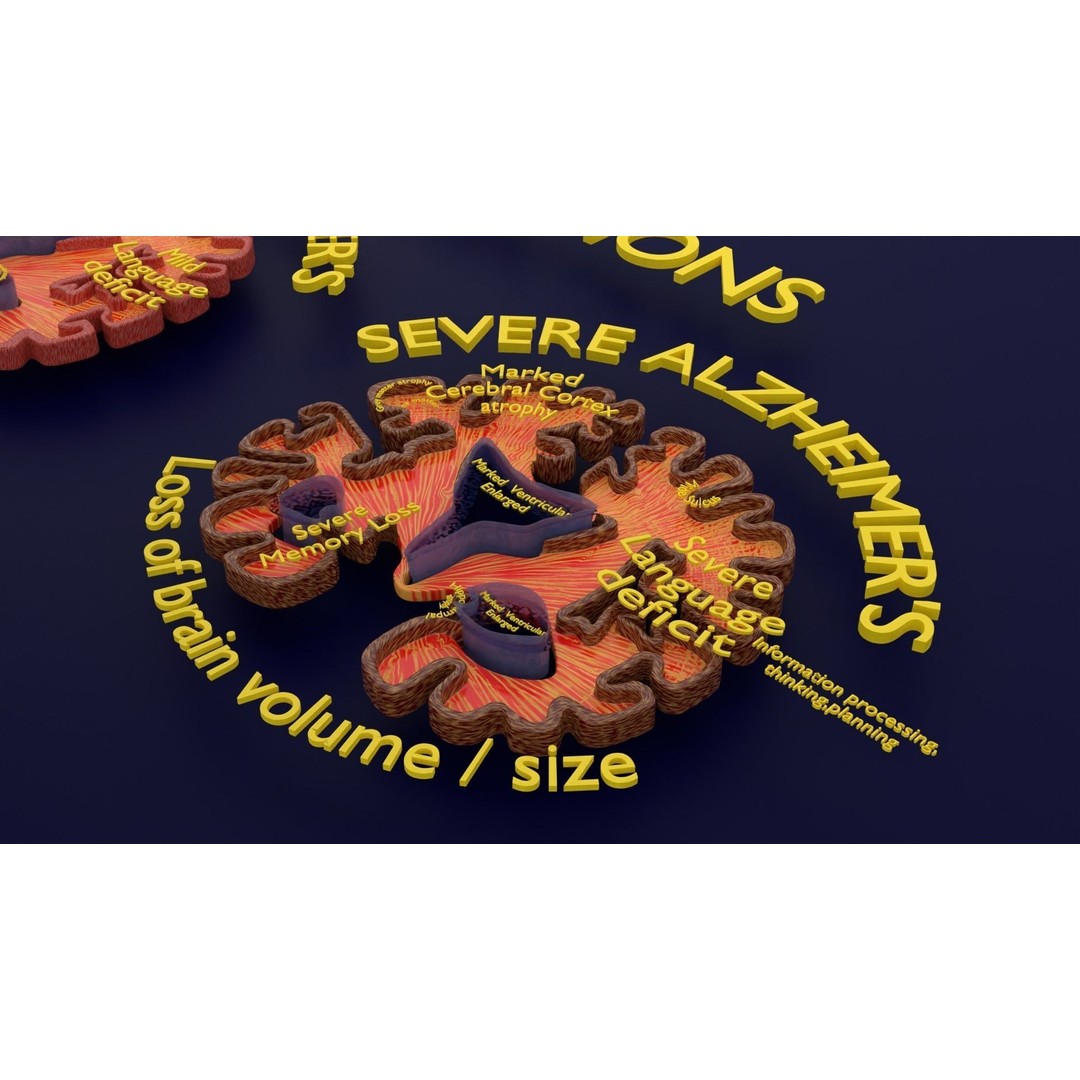 Alzheimer Disease Brain Coronal Slice 3D Model – PBR Textured, Multiple Formats - View 45