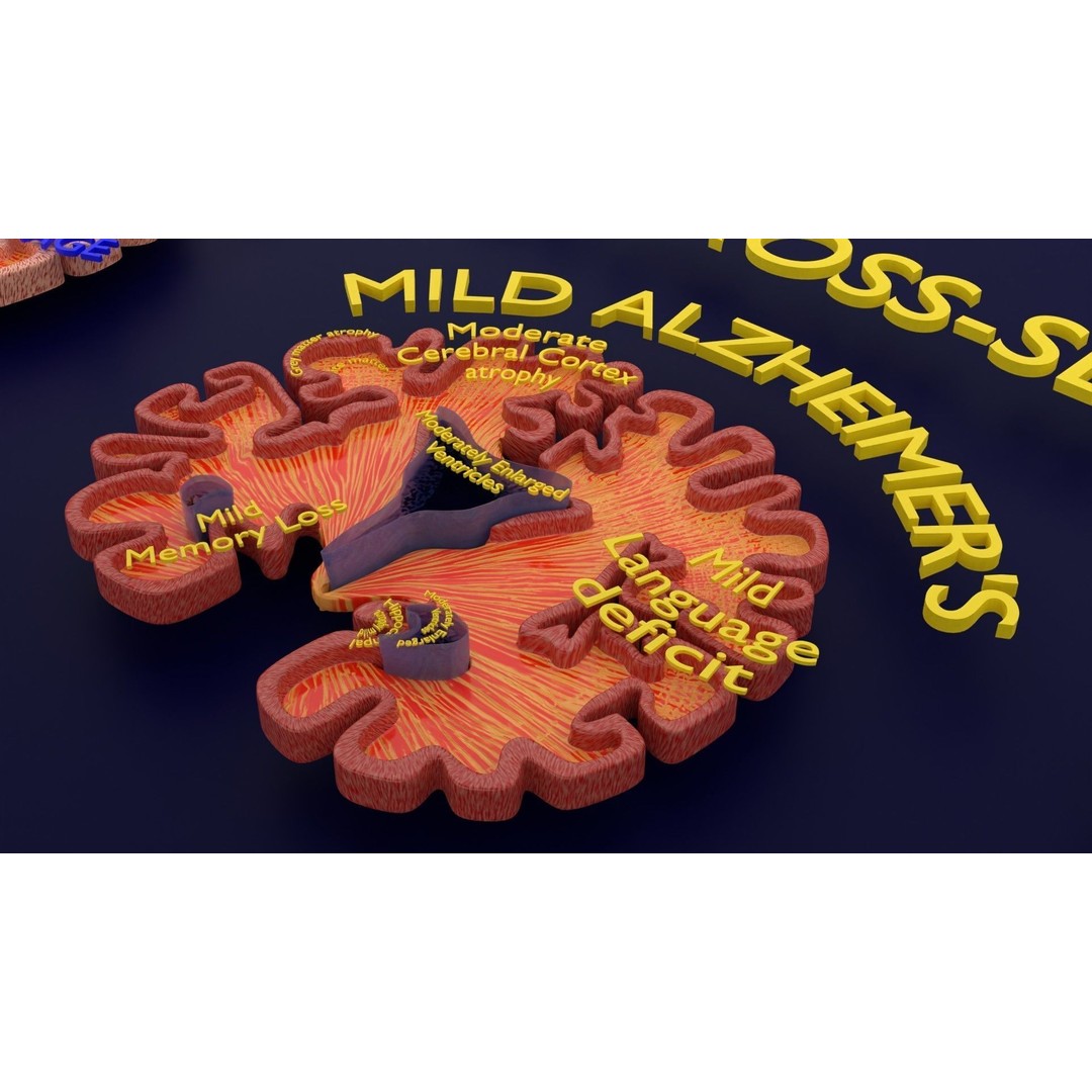 Alzheimer Disease Brain Coronal Slice 3D Model – PBR Textured, Multiple Formats - View 46