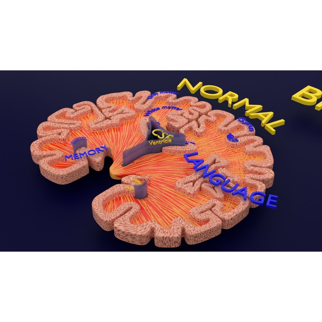 Alzheimer Disease Brain Coronal Slice 3D Model – PBR Textured, Multiple Formats - View 47
