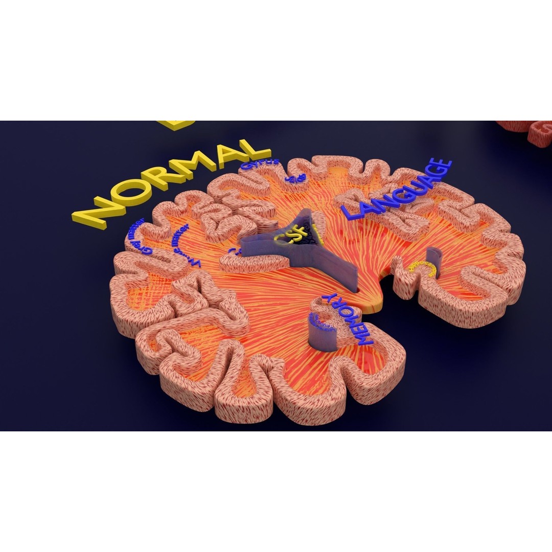 Alzheimer Disease Brain Coronal Slice 3D Model – PBR Textured, Multiple Formats - View 48
