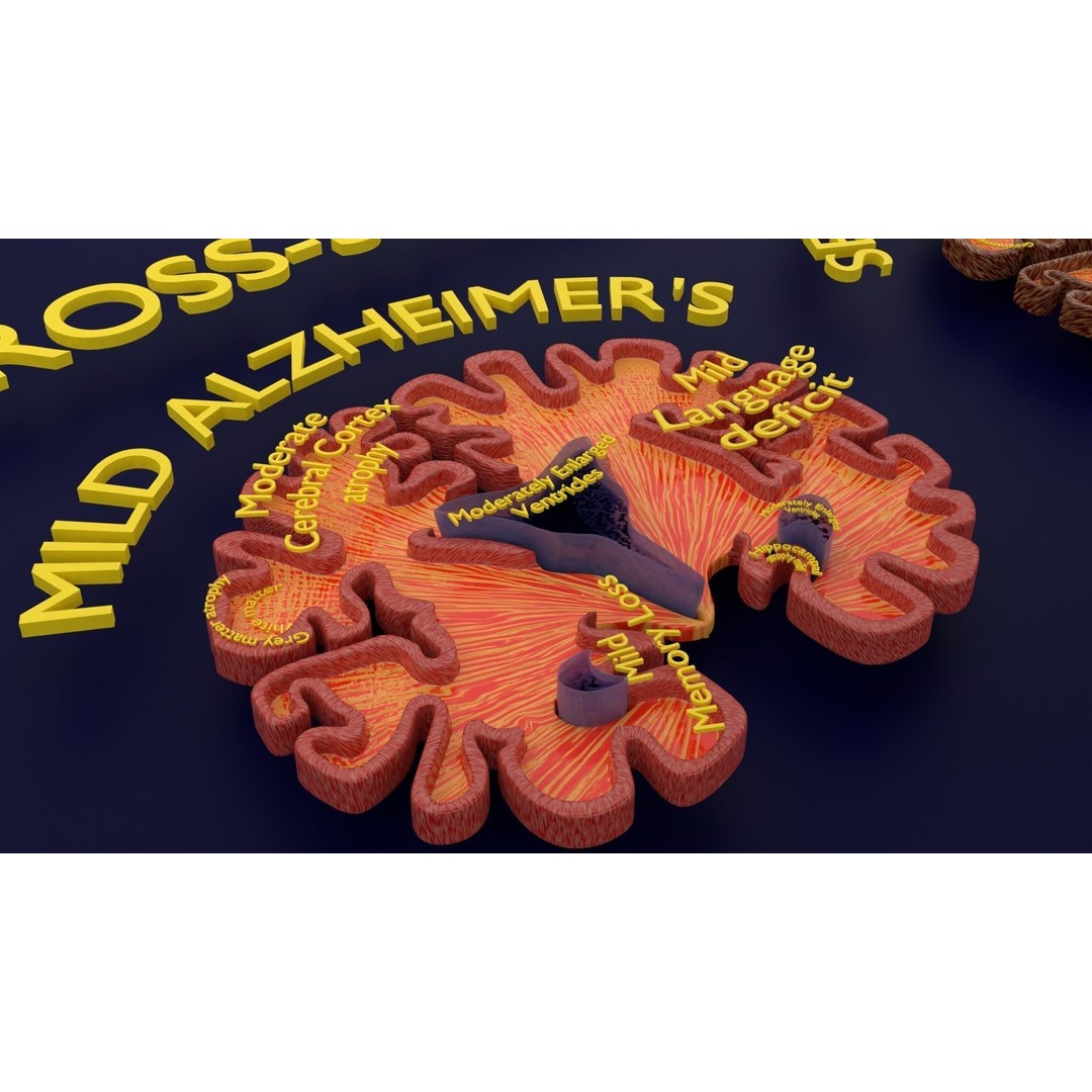 Alzheimer Disease Brain Coronal Slice 3D Model – PBR Textured, Multiple Formats - View 49
