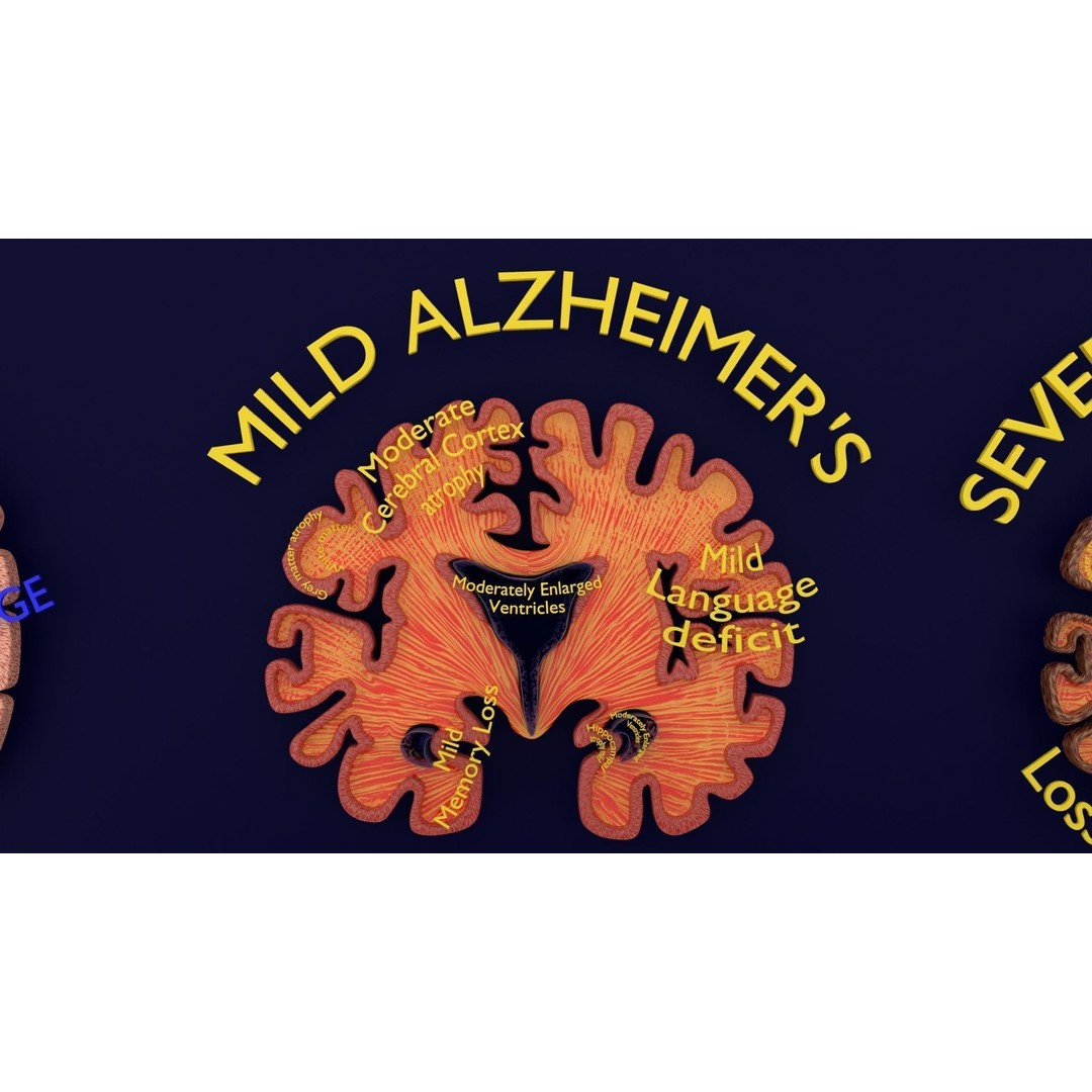 Alzheimer Disease Brain Coronal Slice 3D Model – PBR Textured, Multiple Formats - View 5