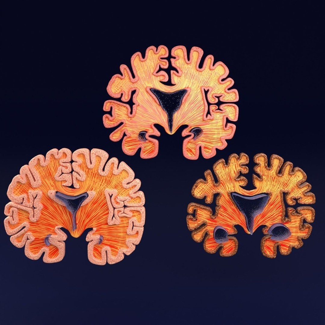 Alzheimer Disease Brain Coronal Slice 3D Model – PBR Textured, Multiple Formats - View 50