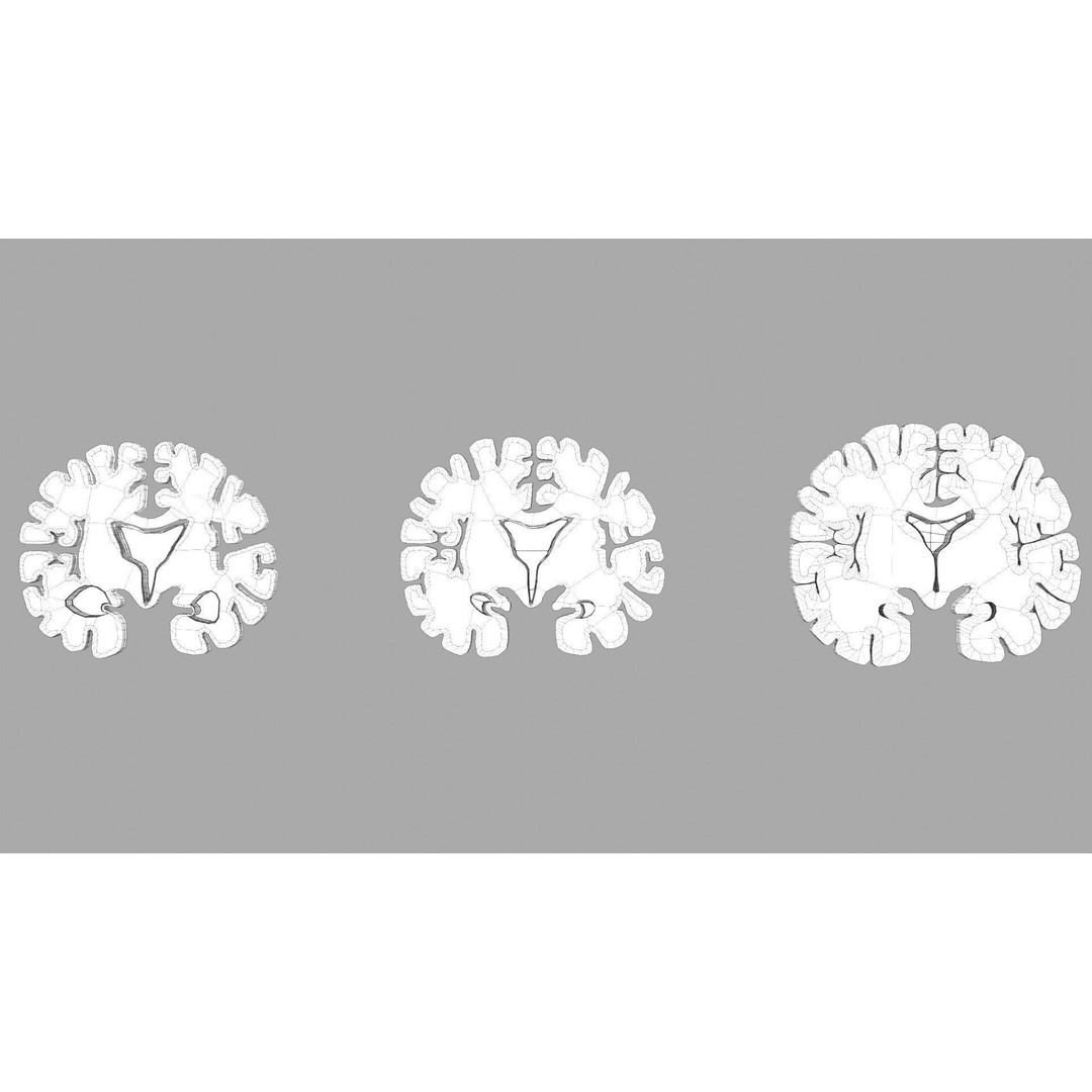 Alzheimer Disease Brain Coronal Slice 3D Model – PBR Textured, Multiple Formats - View 59