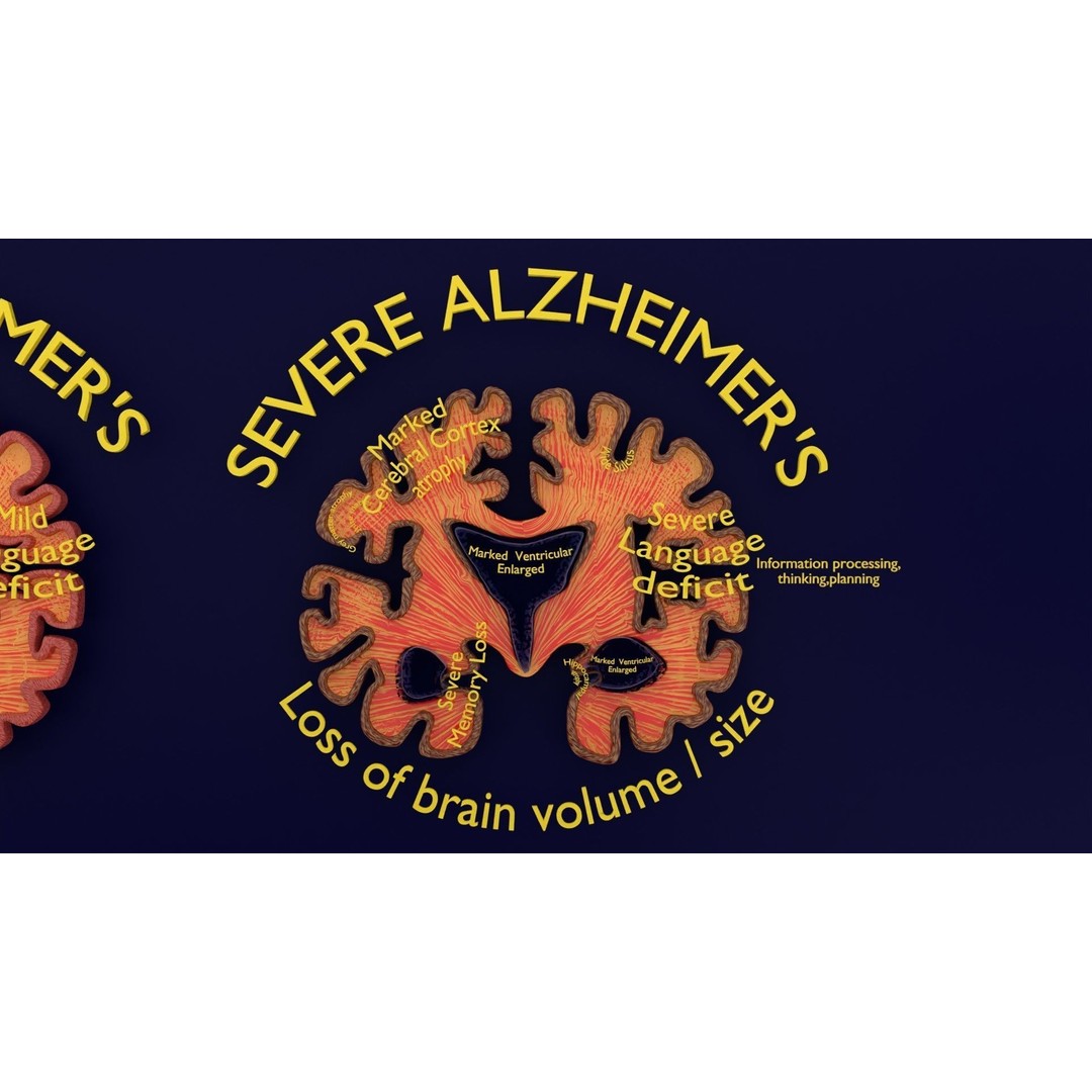 Alzheimer Disease Brain Coronal Slice 3D Model – PBR Textured, Multiple Formats - View 6